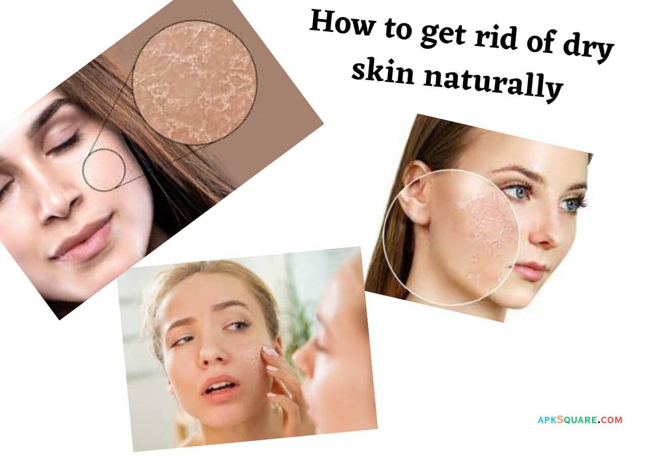 How to get rid of dry skin naturally